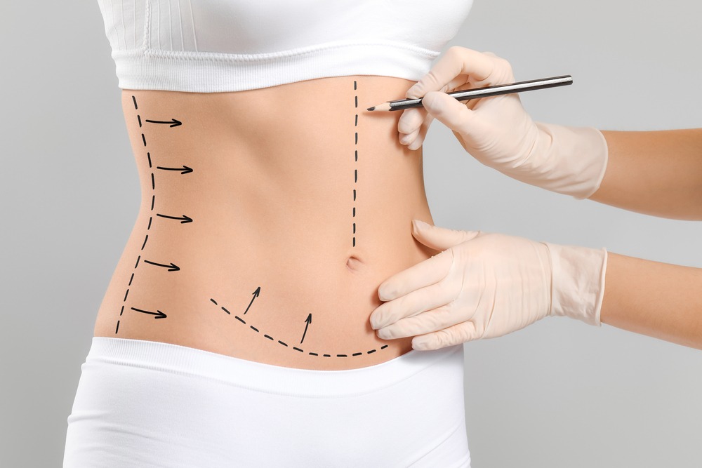 Liposuction