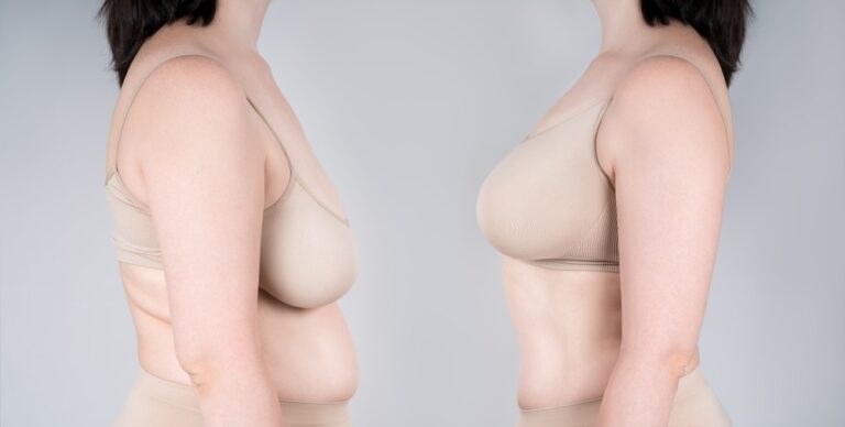 Breast Aging and Sagging | Southwest Michigan Plastic & Hand Surgery