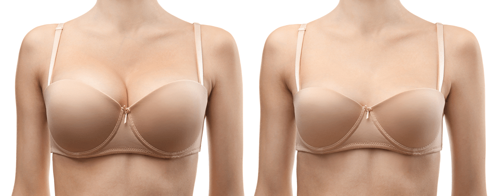 Breast reduction before and after image