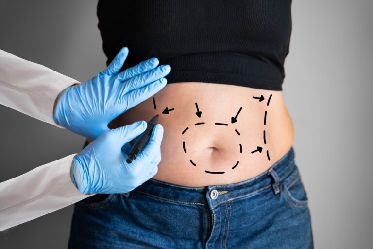 Liposuction | Southwest Michigan Plastic and Hand Surgery