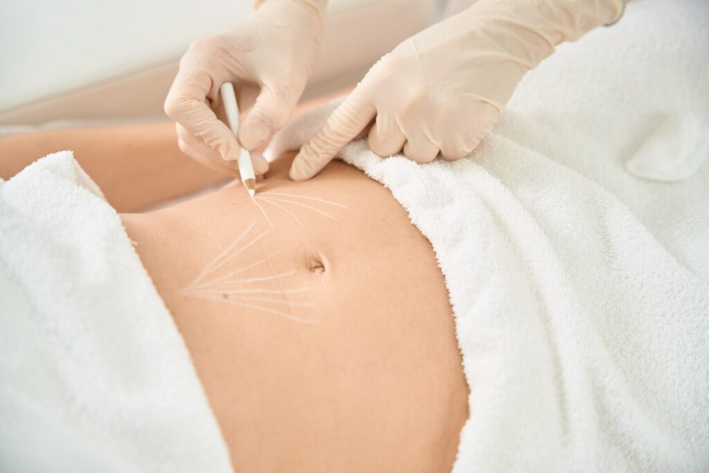 A provider wearing gloves prepares a patient for a body lift, an alternative to the Brazilian butt lift treatment in Portage