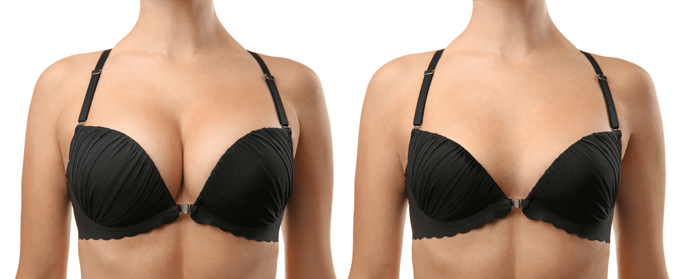 image showing the difference between breast implants and augmentation