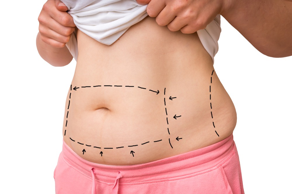 Liposuction Recovery | Southwest Michigan Plastic and Hand Surgery