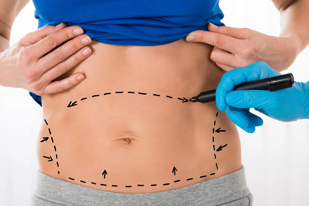 a photo of a woman about to get a tummy tuck