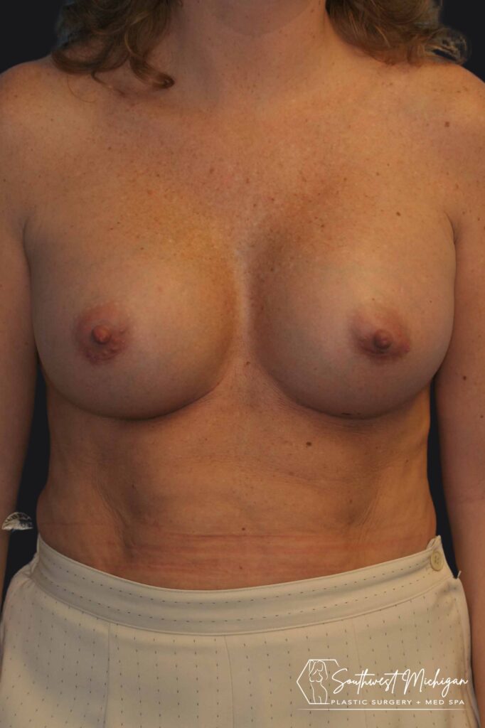 after breast augmentation