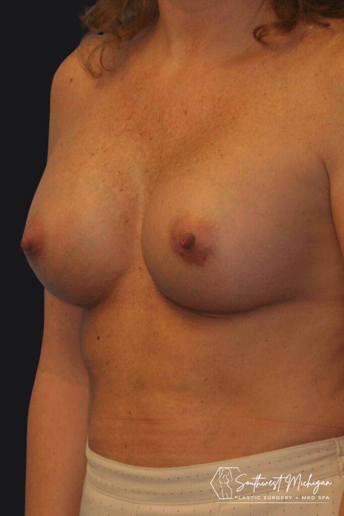 after breast augmentation