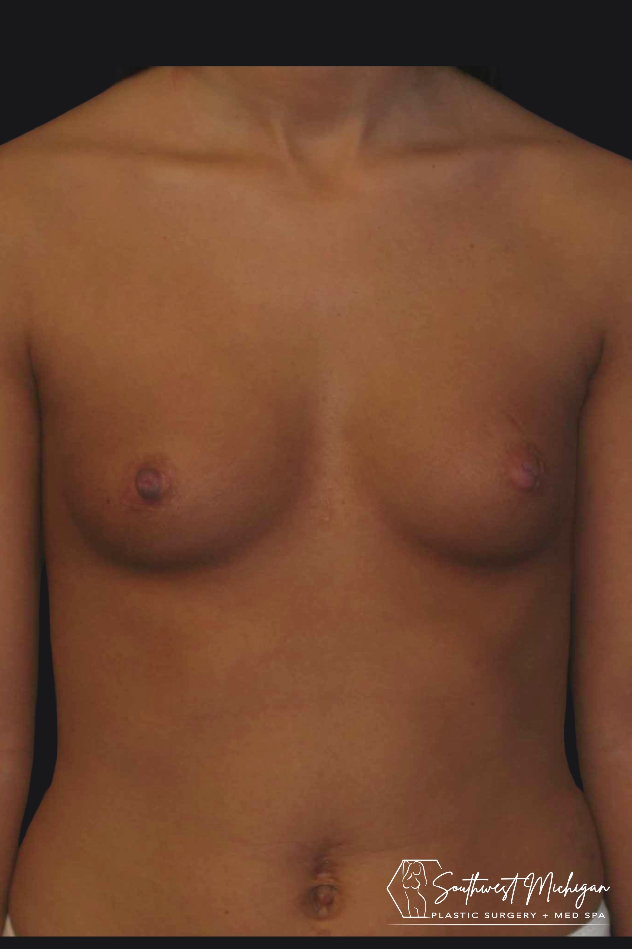 Breast augmentation prior