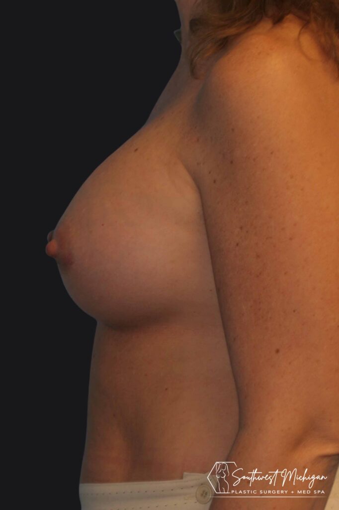 after breast augmentation