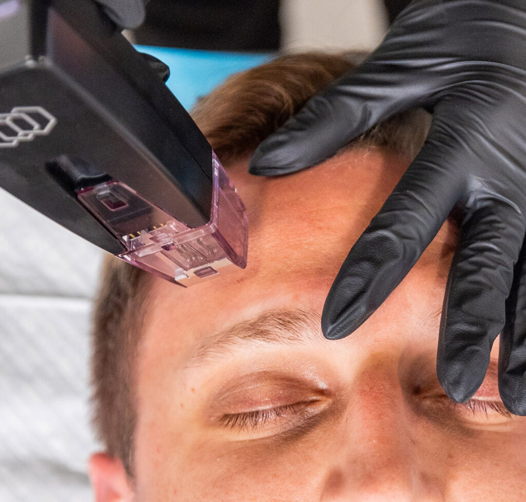 A closeup photo of a man's forehead as he receives Acne Scar Treatment in Portage