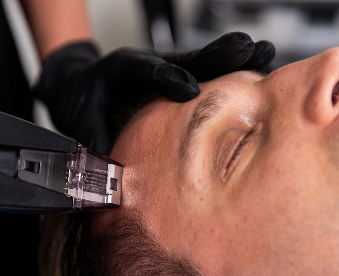 Another close-up photo of a man's face as our provider performs Acne Scar Treatment in Portage