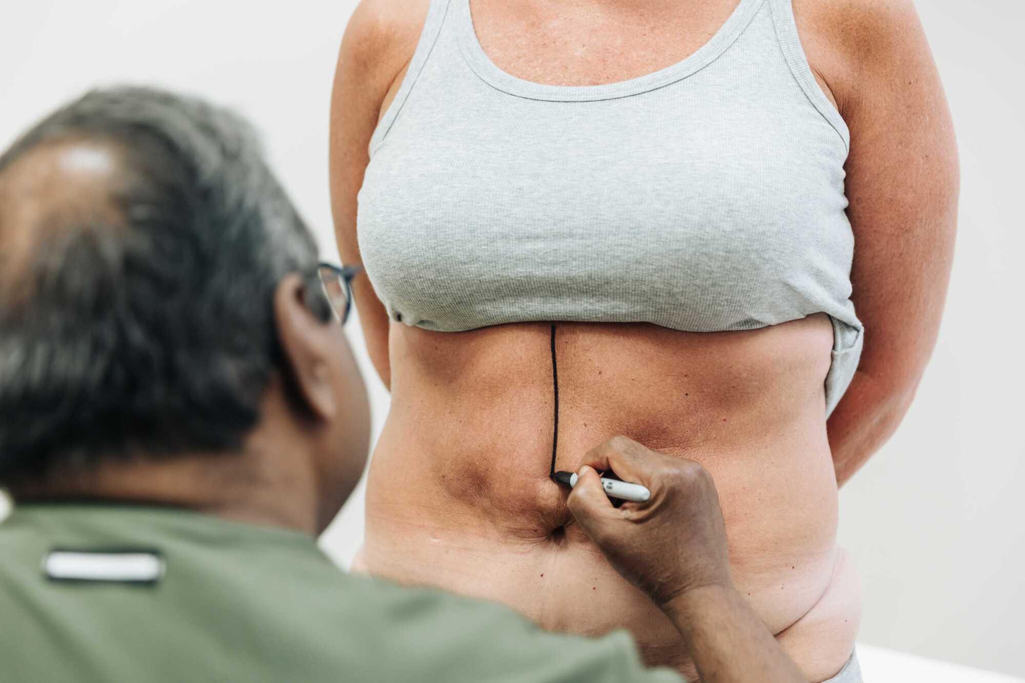 A provider draws on a patient's stomach to prepare them for plastic surgery near Kalamazoo.