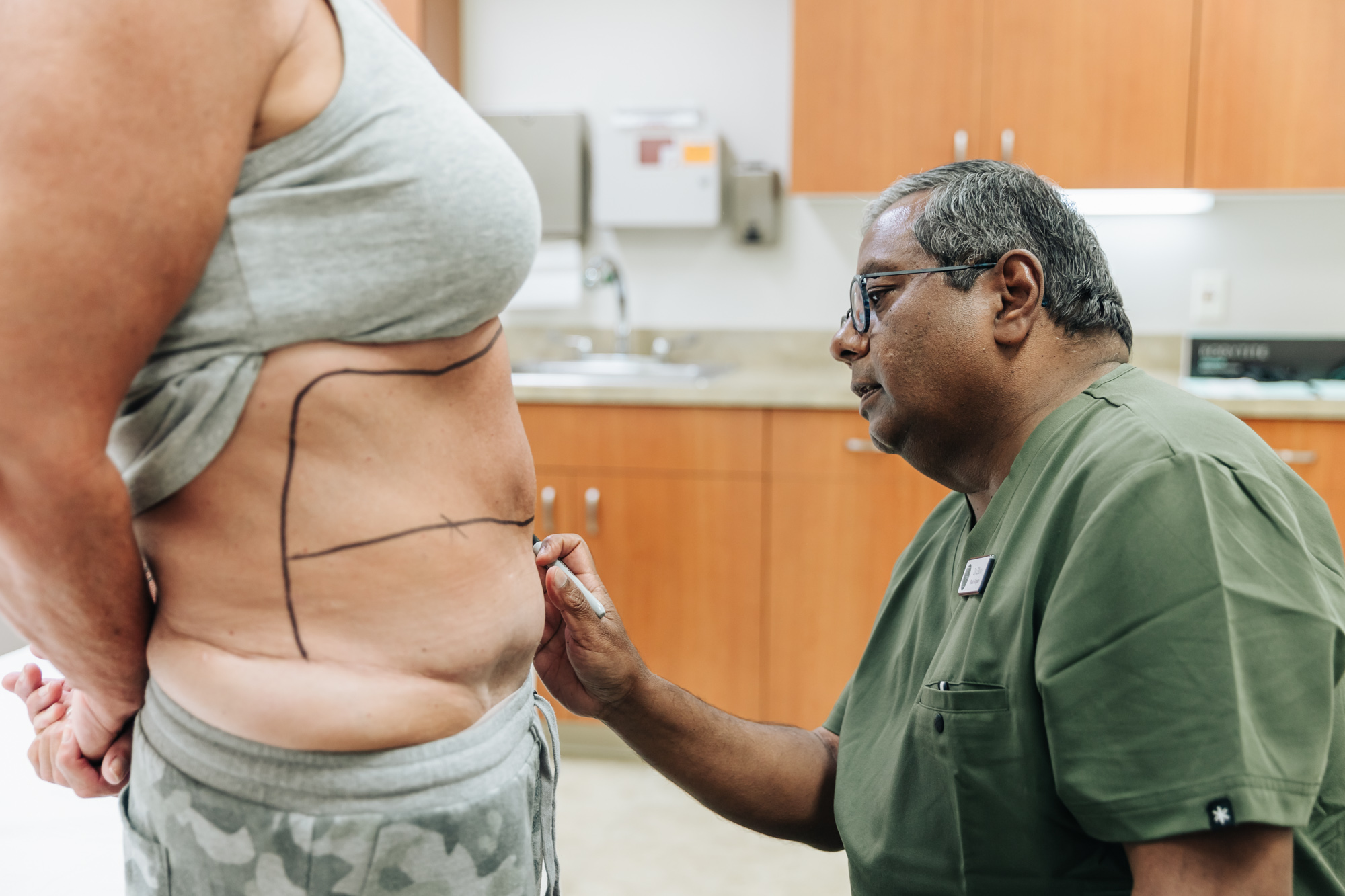 A provider uses a marker to note the treatment area for liposuction near Kalamazoo.