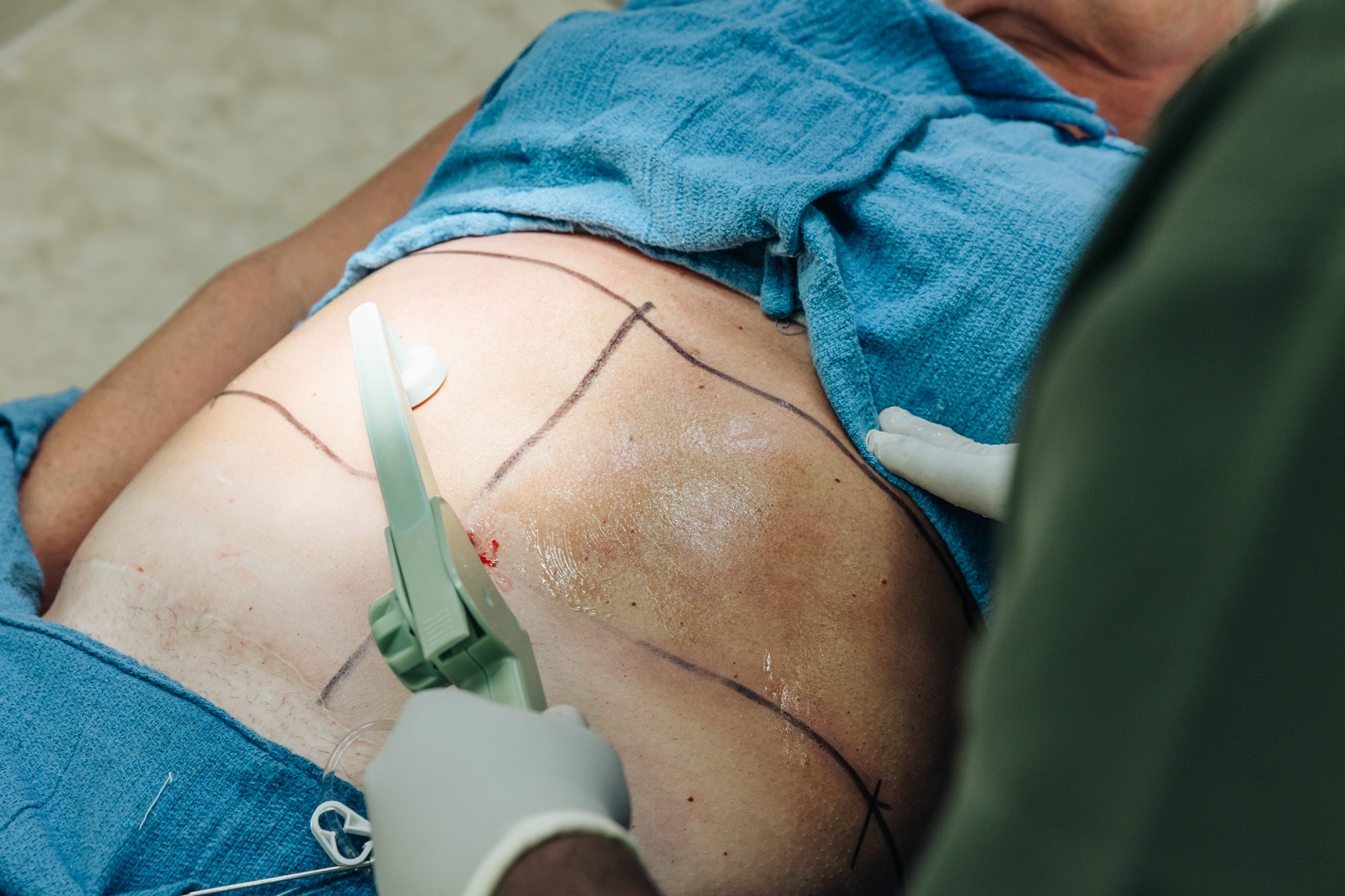 A close-up of a patient's stomach as they receive a BodyTite treatment for non surgical fat removal in Portage.